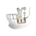 Prosthetic Kit