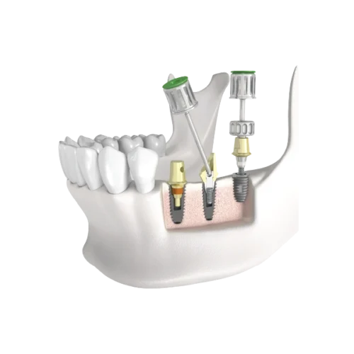 Prosthetic Kit